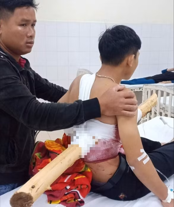 Quảng Ngãi Cứu sống thiếu niên bị cây keo đâm xuyên người