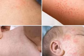 TP.HCM tiếp tục tăng cường phòng chống bệnh sởi