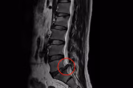 Sợ mổ thoát vị đĩa đệm phải nằm liệt cả tuần, không ngờ sau 2 ngày đi lại dễ dàng