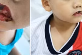 Bé trai mắc hội chứng dị ứng nặng sau khi uống thuốc