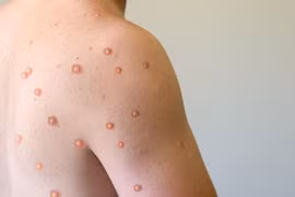 Kiên Giang đã ghi nhận 3 trường hợp mắc bệnh đậu mùa khỉ