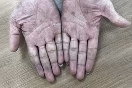 Gia tăng tái nhiễm giang mai ở người quan hệ đồng giới