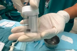 Hóc dị vật cuống trái xoài khiến một trẻ nguy kịch