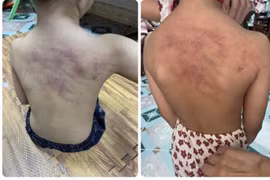 Hải Phòng: Phân công nhiệm vụ khác với giáo viên phụ trách lớp có trẻ bị bầm tím lưng khi đi học