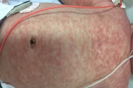 Hà Nam: Chủ động phòng chống bệnh Sởi/Rubella, giảm thiểu nguy cơ bùng phát dịch