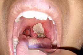 Người dân không để tâm lý hoang mang vì tin sai lệch về bệnh bạch hầu