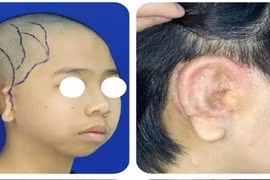 Tái tạo khuôn mặt cho cháu bé trước khi vào lớp 1