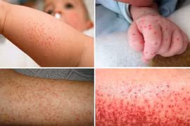 Người mắc sốt xuất huyết tại Hà Nội tăng mạnh