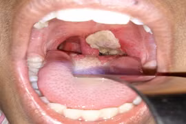 Bộ  Y tế: Cần lấy mẫu xét nghiệm, điều trị kháng sinh dự phòng với người nghi mắc bệnh bạch hầu