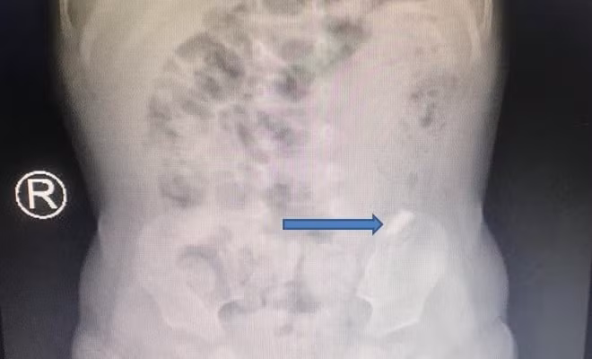 Trên phim X-quang, các bác sĩ ghi nhận mảnh kính di chuyển trên đường tiêu hoá của bệnh nhi, khả năng gắp ra bằng nội soi rất khó.
