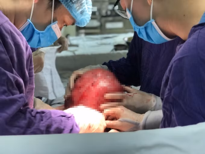 Kíp phẫu thuật hoàn thành việc đưa khối u ra khỏi cơ thể chị C. (ảnh TL).