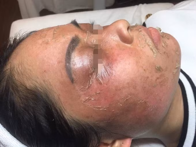 Chị T. cho biết, da mặt nhiều khách hàng của Spa bị hư tốn nặng do sử dụng mỹ phẩm mà Công ty Linh Ngân phân phối (Ảnh:NVCC).