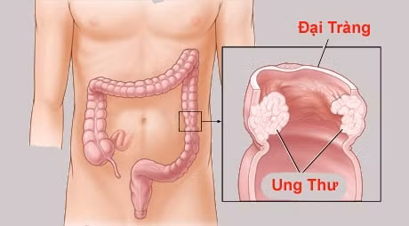 vi sao viem dai trang de tro thanh benh man tinh hinh 2