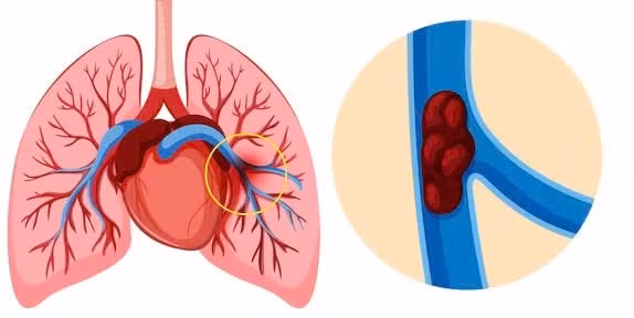 Bệnh nhân nguy kịch do thuyên tắc phổi do sử dụng thuốc tránh thai kéo dài.