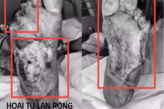 Hoại tử hai bàn chân sau khi tự chườm nóng hai bàn chân
