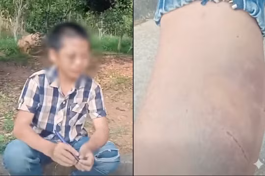 Bé trai lớp 6 ở Nghệ An khóc nức nở, kể chuyện bị mẹ kế đánh bầm tím người