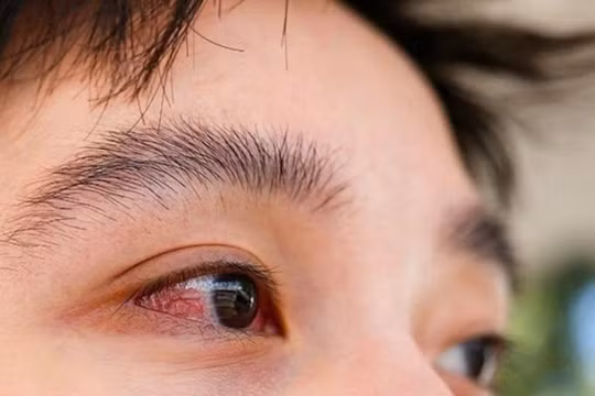 Ca đau mắt đỏ do Adeno tăng, Bộ Y tế khuyến cáo không tự ý nhỏ thuốc