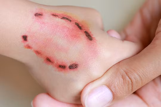Cục Phòng bệnh đề nghị các địa phương đẩy mạnh truyền thông, giám sát phơi nhiễm và xử trí kịp thời, chủ động phòng ngừa bệnh dại. Ảnh tư liệu