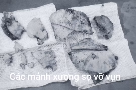 Tông vào đuôi xe container khiến não thoát ra ngoài, nữ bệnh nhân hồi phục sau 12 ngày