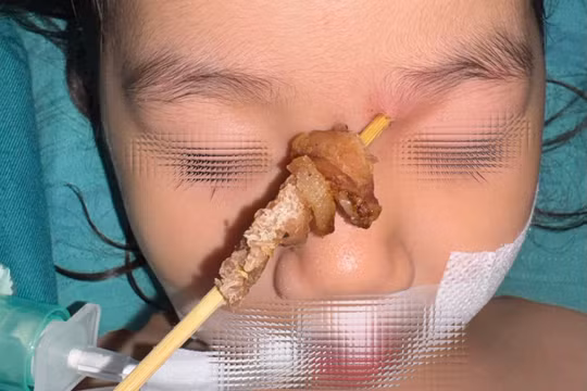 Vừa chạy vừa cầm xiên nướng, bé gái 2,5 tuổi suýt mù vĩnh viễn
