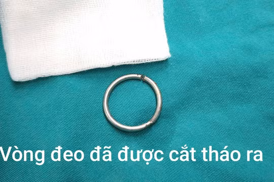Đeo vòng kim loại 3 cm vào vùng kín, nam thanh niên 24 tuổi suýt phải cắt tinh hoàn