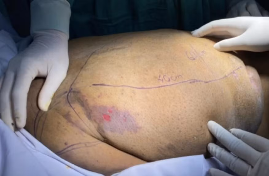 mang mai rua 26 kg nguoi phu nu kho so vi can benh la hinh 2