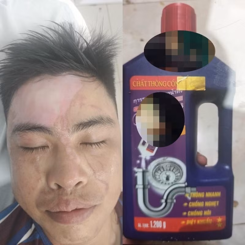 nhieu truong hop bong nang khi su dung chat thong cong sieu toc hinh 1