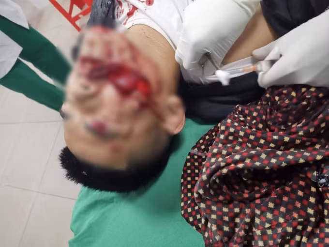 Tr. bị thương nặng ở mặt, môi, má