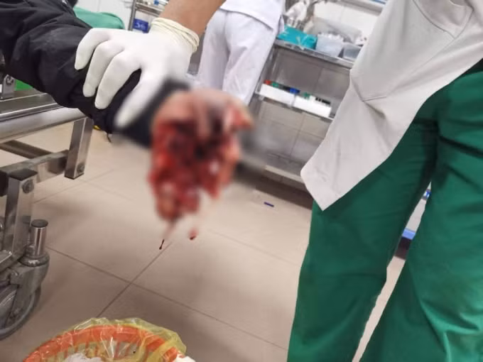H. bị nát bàn tay trái hoàn toàn không thể phục hồi