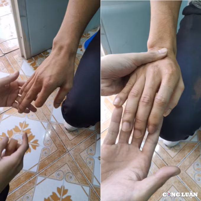 hai chang trai hon 4 nam theo duoi nghe lam mui tay chan gia cho nguoi khiem khuyet hinh 4
