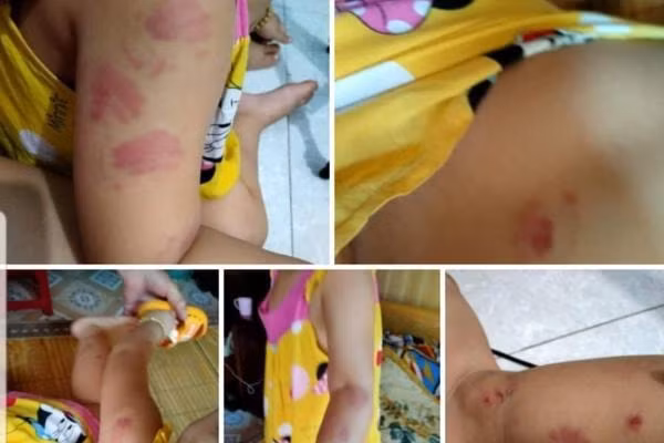 Cháu bé 21 tháng bị cắn tím người. Ảnh: TL.