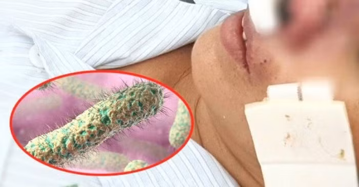 Bốn người chết do liên quan đến bệnh “vi khuẩn ăn thịt người” Whitmore. Ảnh: baogiaothong.vn