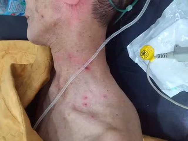 Ông Đ. nhập viện trong tình trạng nguy kịch vì bị ong đốt 100 nốt. Ảnh: doisongvietnam.vn